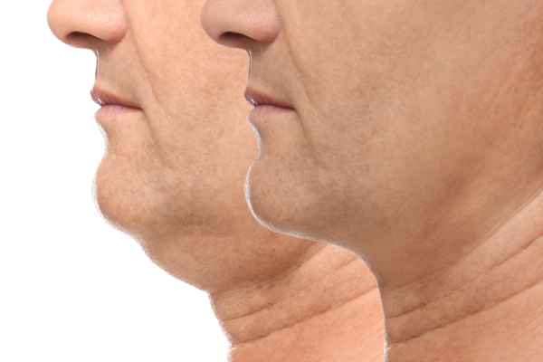 HIFU - Breakthrough in Anti - ageing 2 hifu results Ascot