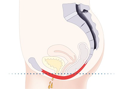 Pelvic-Floor Muscle Repair 5 Pelvic floor muscles Ascot