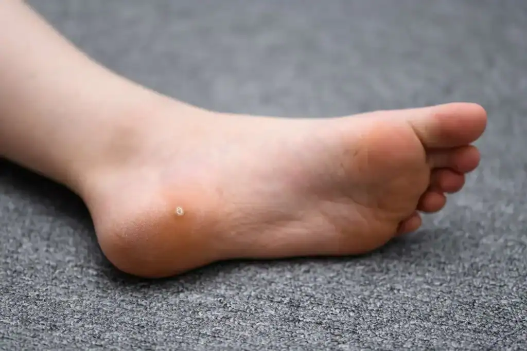 Cryotherapy For Warts And Also Verrucas 2 Image of verruca on the bottom of the foot that able to be treated with Cryotherapy Ascot