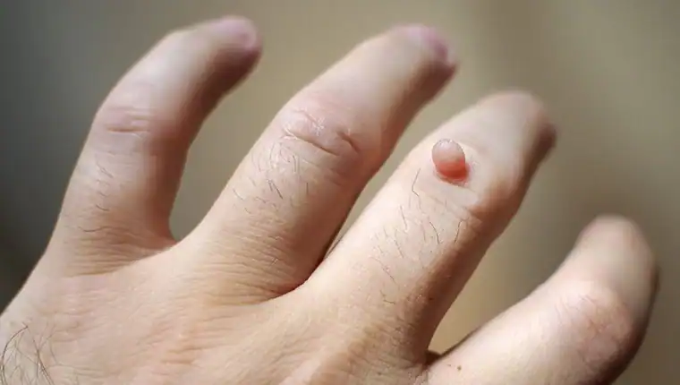 Cryotherapy For Warts And Also Verrucas 1 Image of blemish that Cryotherapy Ascot can remove with Lipo 360.