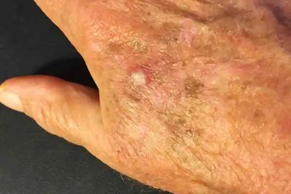 Image of Actinic keratoses Ascot on a person hand