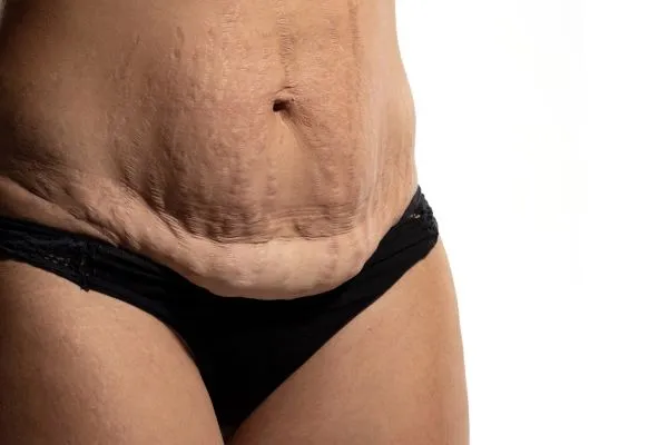The science behind skin tightening Ascot picture of a woman's sagging skin on the stomach